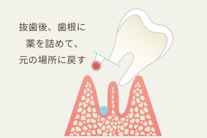 意図的再植術