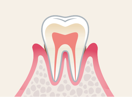 軽度歯周炎