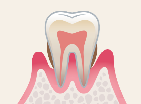中度歯周炎